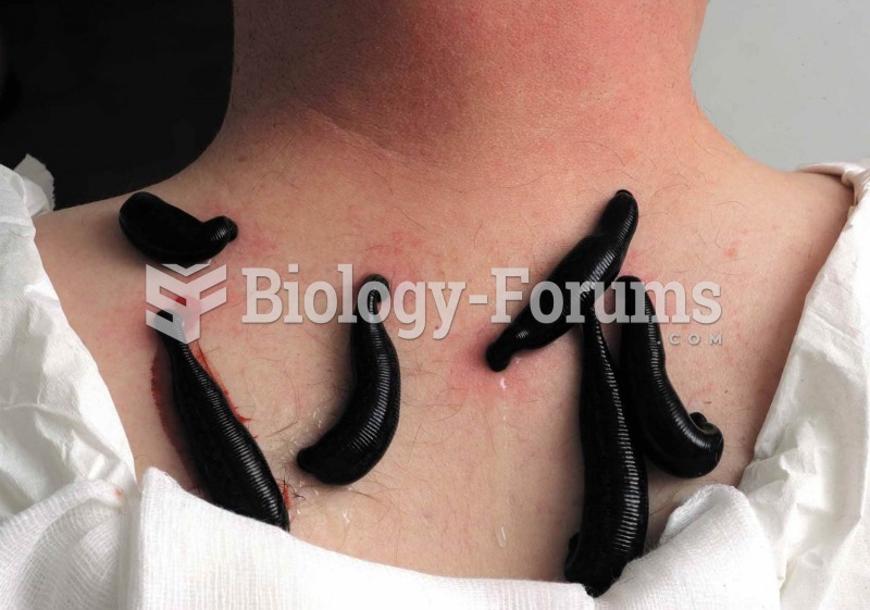 Medicinal leeches on a patient’s neck. Today leeches are sometimes used in microsurgery to prevent b