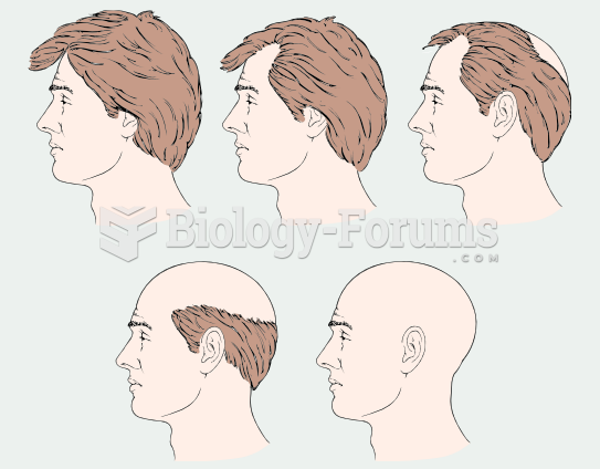 Male Pattern Balding
