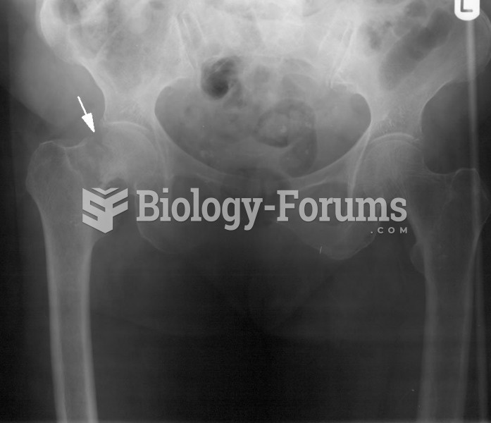 Bone Fracture X-ray
