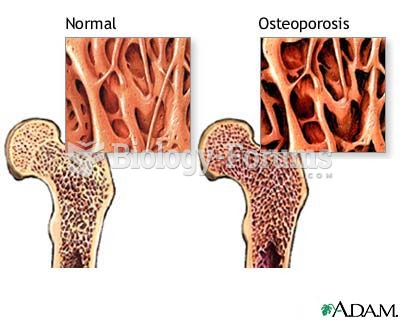 Osteoporosis Cartoon