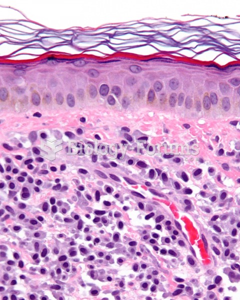 Mastocytosis of skin