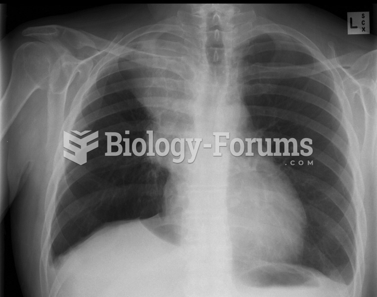 CXR of lung cancer with right phrenic nerve paralysis