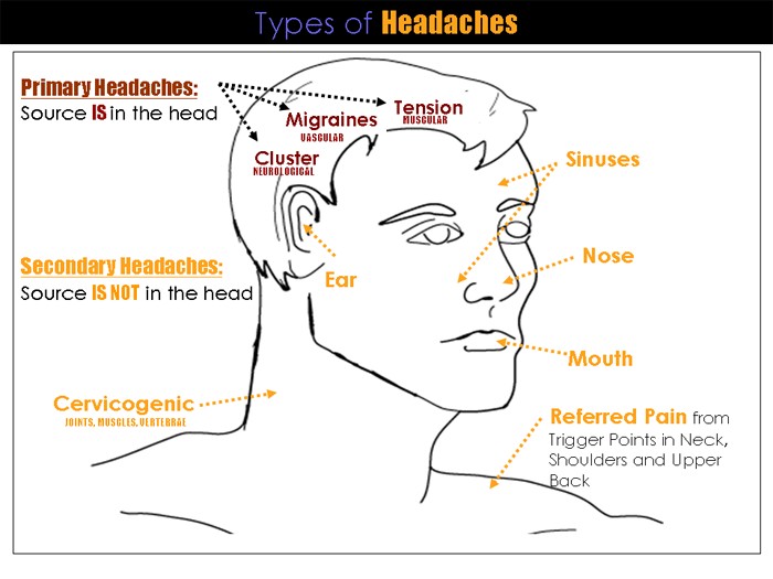 Types of headaches