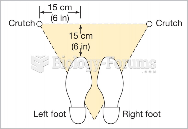 The correct beginning position for the patient’s feet and crutches (tripod position).