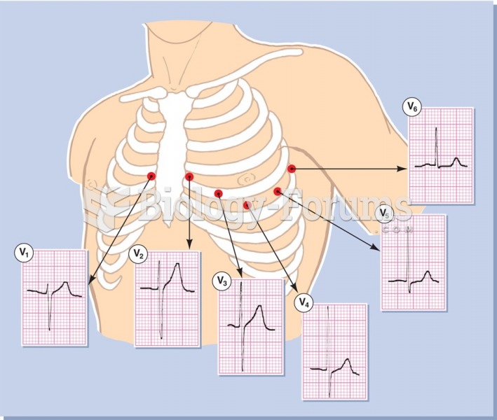 Electrode placement for chest leads V1–V6.