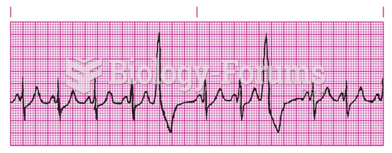 Multifocal premature ventricular contractions (PVCs).
