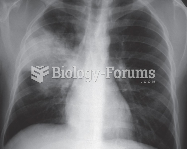 A chest X-ray showing pneumonia characterized by the patch of gray-white areas. 