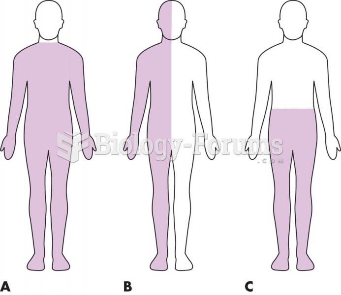 Types of paralysis: (A) quadriplegia; (B) hemiplegia; (C) paraplegia.