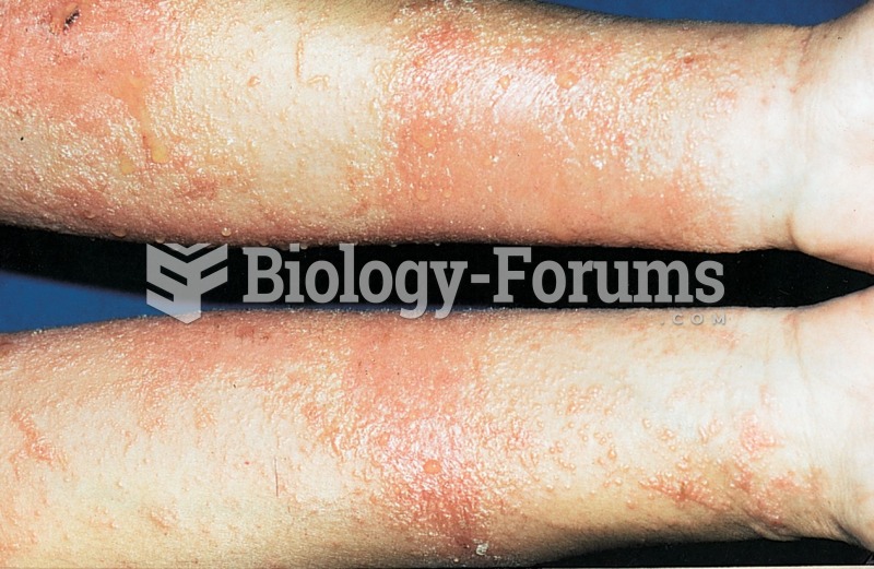 Contact dermatitis resulting from poison ivy. 