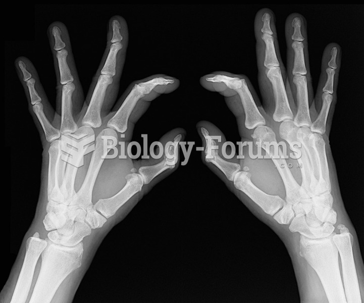 X-ray showing typical joint changes with osteoarthritis. 