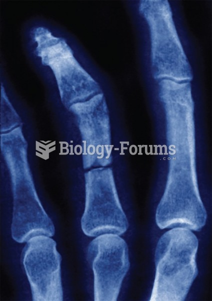 Gouty arthritis of the finger joint. 