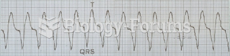 Examples of heart rhythms: ventricular tachycardia.