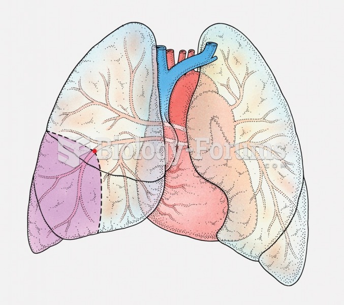 Pulmonary embolism. The purple shaded section shows the area of the lung that is dying from lack of ...