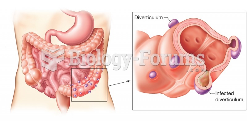 Colon with diverticulosis. An inflamed or infected diverticulum is called diverticulitis.