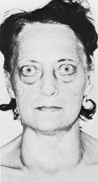 A patient with exophthalmos. 