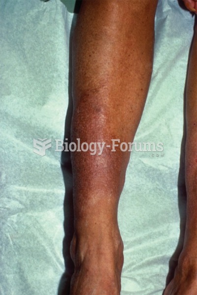 Dermatological changes with myxedema can occur behind the eyes or in the lower leg, as shown here.