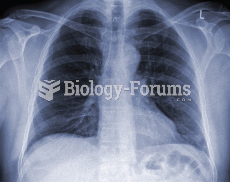 An X-ray showing pneumonia.