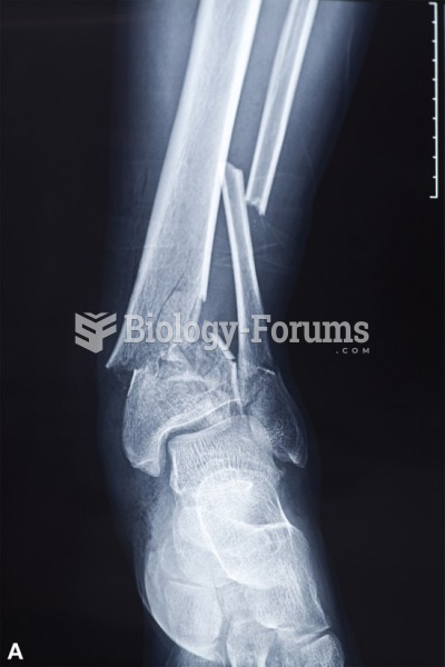 An X-ray of the complete fracture of a radius. 
