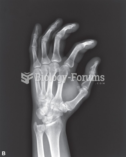 An X-ray of arthritic joints of the wrist and hand.
