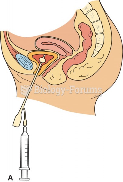 Foley catheter: The inflated balloon at the tip of the catheter holds the Foley catheter in place in ...