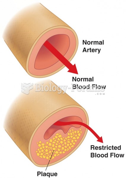 Plaque Buildup in Arteries