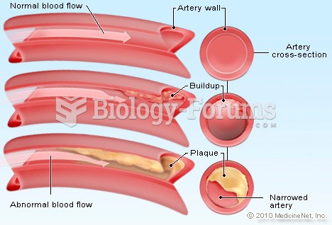 Blood flow in artery due to Cholesterol