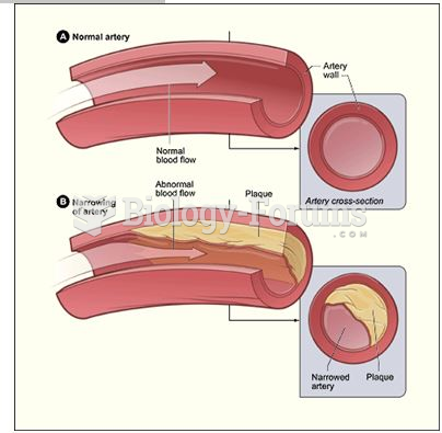 Normal artery versus plaque formation