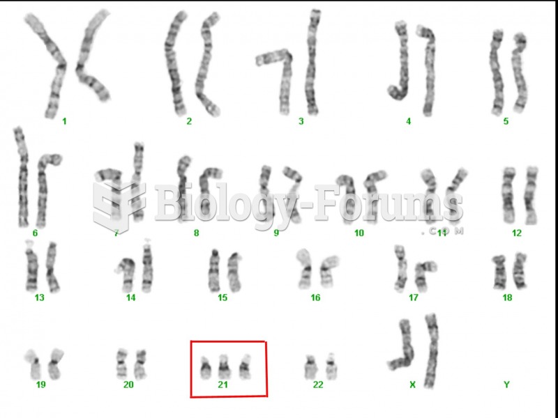 Karyotype for Down's Syndrome