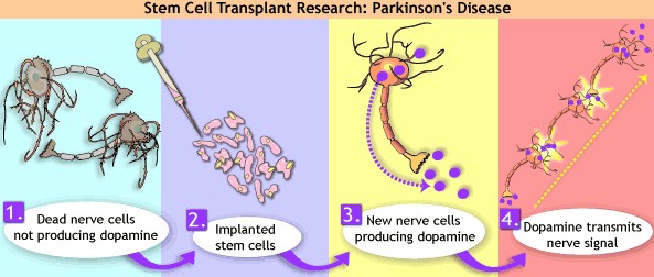 Patients with Parkinson's disease embroyonic stem cell treatment