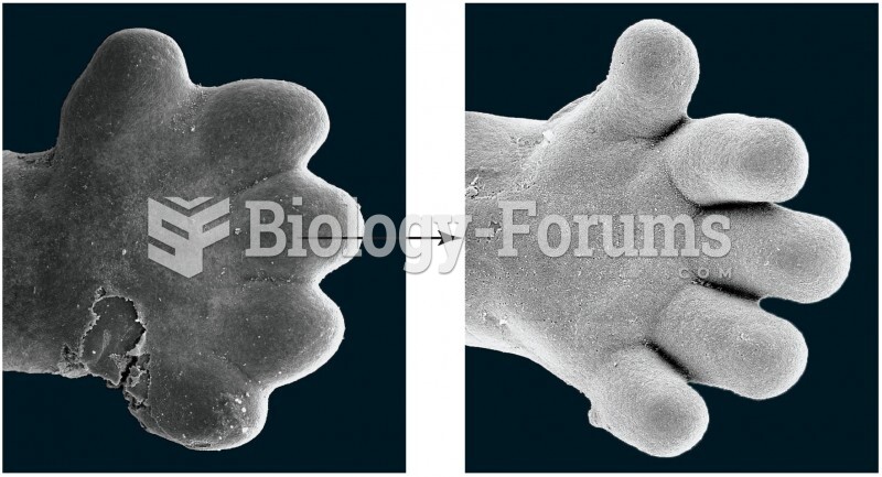 Apoptosis in the formation of a human hand