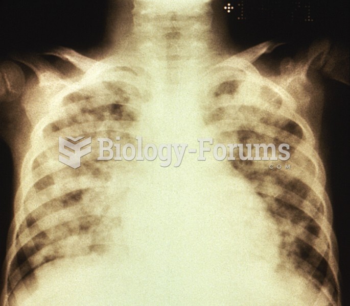 X-ray showing pneumonia. Fluid and blood cells fill the lungs