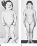 (A) A 6-year-old child with congenital hypothyroidism, cretinism, exhibiting marked mental and physi