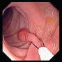 Endoscopic view of a polyp in the colon. Note the mushroom-like shape, an enlarged top growing at th