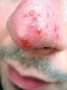 Inflammation as illustrated by cellulitis of the nose. Note that the area is red and swollen. It is