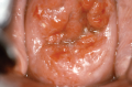 Carcinoma in situ (CIS) of the cervix. Photograph of the cervix as seen during a gynecological exam.