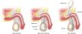 Penile implants. (a) Semirigid rods may be surgically implanted into the penis, which provides a par