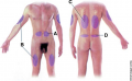 Subcutaneous injection sites