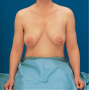 Position of Patient for Breast Inspection: Arms at Side