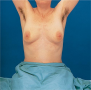 Position of Patient for Breast Inspection: Arms Overhead