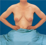 Position of Patient for Breast Inspection: Hands Pressed Against Hips