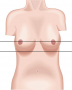 Deviation of Nipples, Symmetrical without Deviation