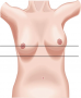 Deviation of Nipples, Asymmetrical with Deviation