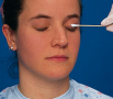 Assessing Palpebral Conjunctiva, Everting the Eyelid