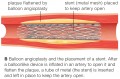 Balloon Angioplasty and Stent