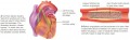 Two ways of treating blocked coronary arteries, the main cause of heart attacks in older adults.