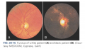 Fundus of white pateint and black patient