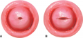 Cervix Pre&post pregnancy