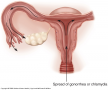 Pelvic inflammatory disease. Chlamydia or gonorrhea spreads up the vagina into the uterus and then t