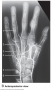 Anteroposterior View of the hand skeleton