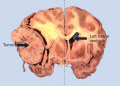 Meningioma